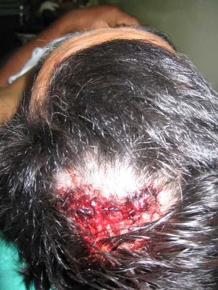 Entre las heridas por golpes esta la cabeza de Marcial Hernandez. Foto: Sandra Cuffe